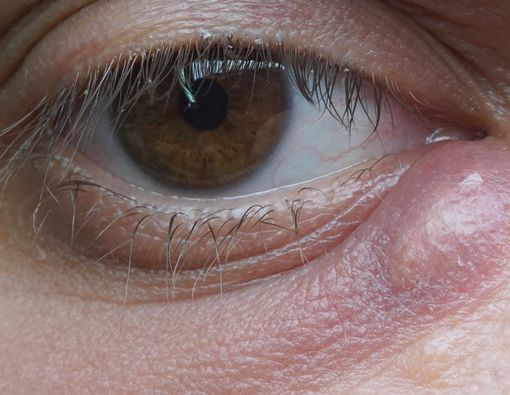 Cara Mengatasi Bintitan Tanpa Obat