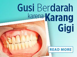 Gusi Berdarah karena Karang Gigi