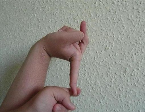 Mengenal Gejala Penyakit Kulit Langka Sindrom Ehlers-Danlos