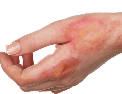 Sangat Langka, Kenali Penyakit Drakula Ini