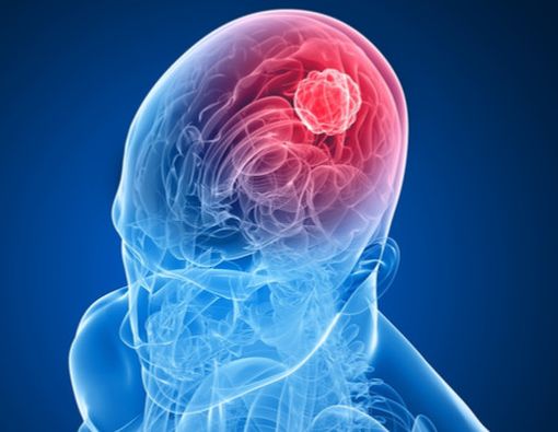 Benarkah Telinga Berdenging, Tanda Tumor Otak?