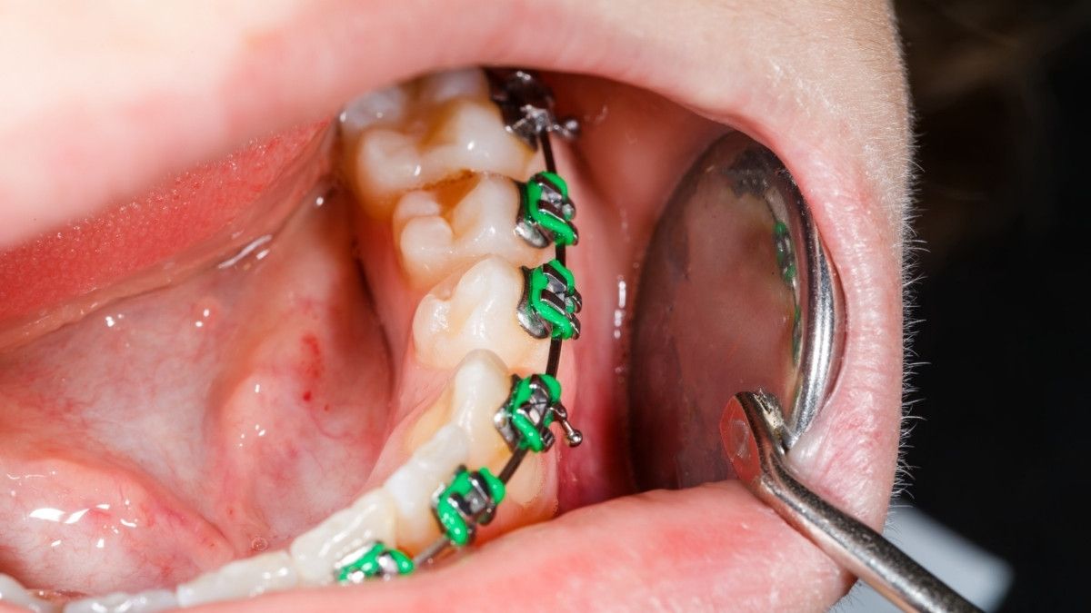 Pakai Behel Lepas Pasang, Waspadai Bahaya Ini