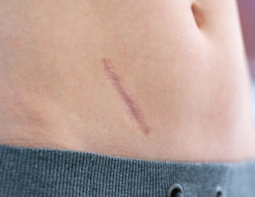 Luka Tusuk Bisa Sebabkan keloid?