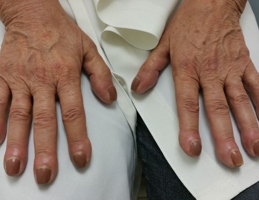 Clubbing Finger Bisa Indikasikan Masalah Jantung