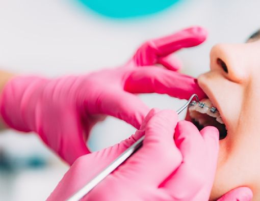 Perawatan Behel yang Terlalu Lama Bikin Gigi Ngilu?