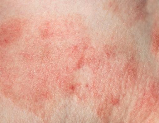 Daftar Penyakit yang Ditandai dengan Flu dan Ruam Kulit