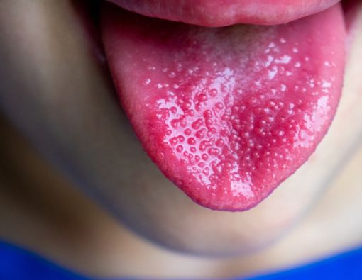 Lidah Stroberi, Gangguan Lidah yang Bisa Mengancam Nyawa