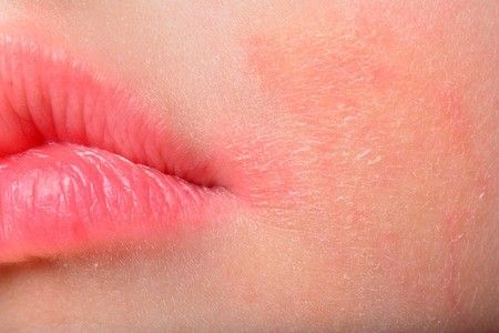 Virus Zika Dapat Ditularkan Melalui Hubungan Seksual, Benarkah?