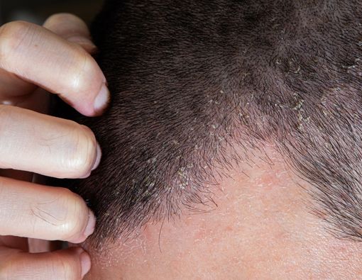 Cara Terbaik Mengatasi Dermatitis Seboroik