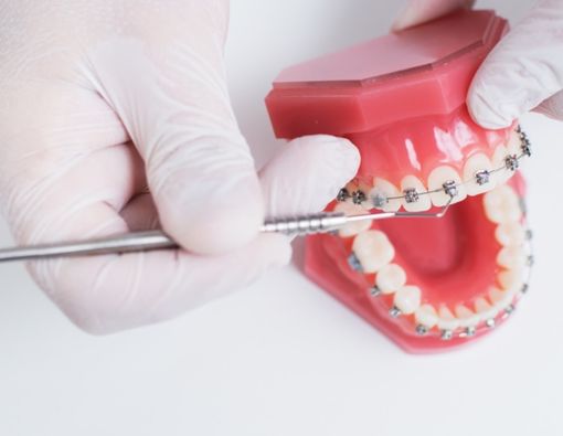 Bolehkah Pasang Kawat Gigi saat Hamil?