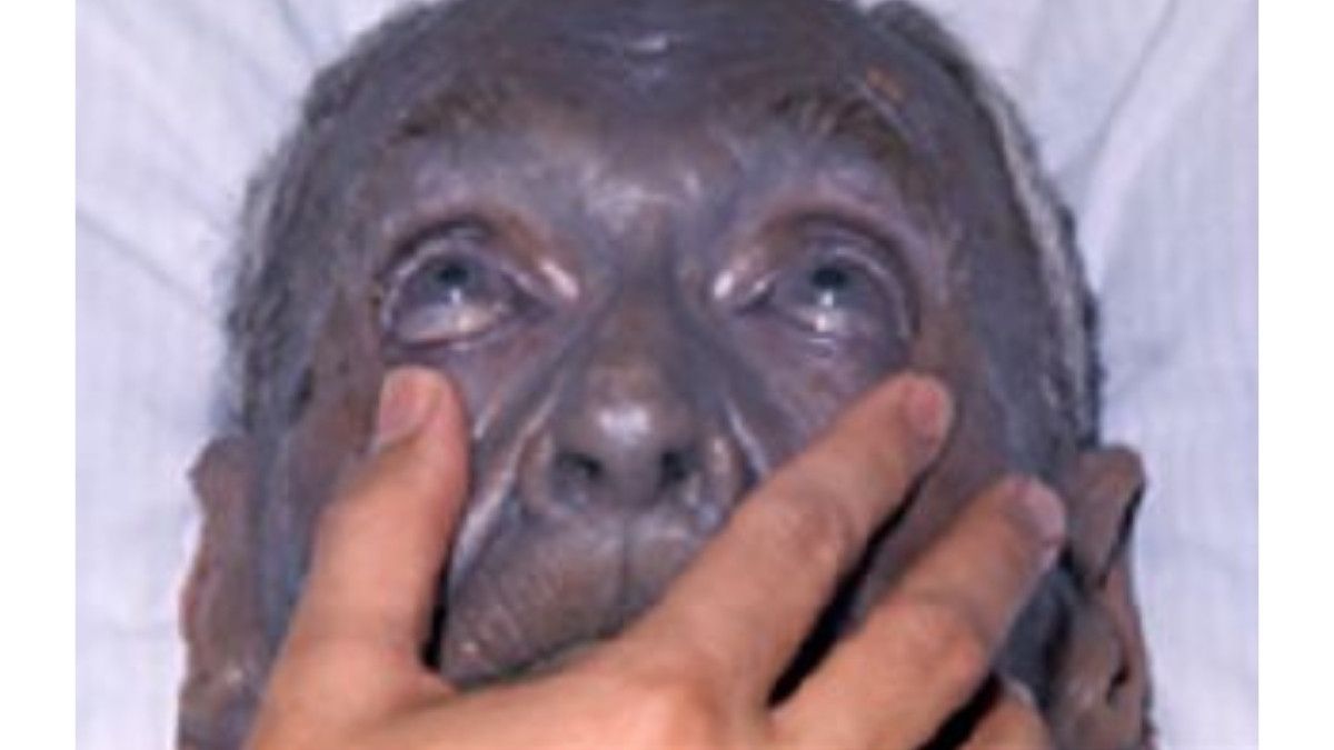 Argyria, Penyakit yang Bikin Kulit Berwarna Biru Keabu-Abuan