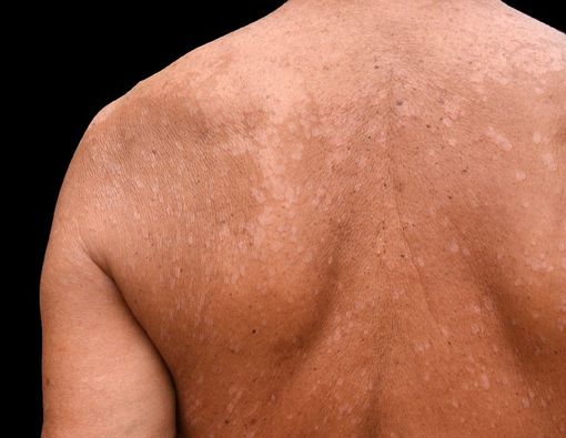 Mencegah dan Mengatasi Panu dengan Pola Makan Tepat