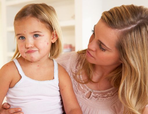 Ibu, Lakukan Ini Saat Anak Kena Cacar Air