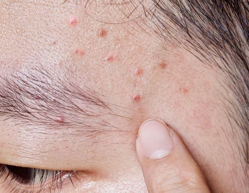 Sering Beruntusan, Ketahui Cara Hilangkan Jerawat Pasir