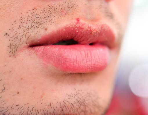 Mengenal Fordyce Spot, Benjolan di Kelamin yang Mirip Kutil