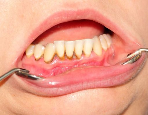 Sering Mengalami Gusi Berdarah? Anda Mungkin Menderita Gingivitis