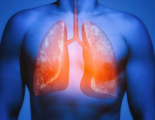 Kelainan Genetik Ini, Bisa Tingkatkan Risiko PPOK