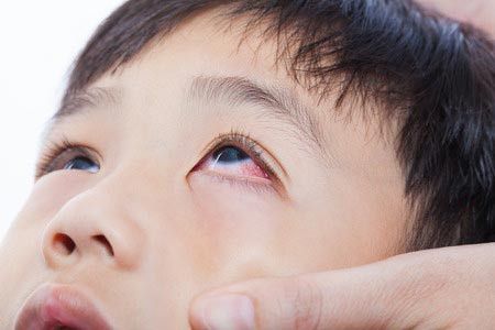 Berbagai Jenis Penyakit Mata yang Umum Terjadi