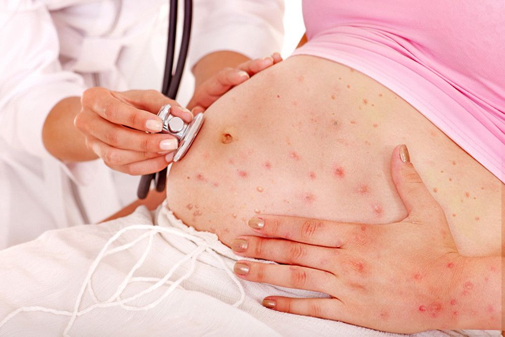 Benarkah Cacar Air Saat Hamil Picu Gangguan Pada Rahim?