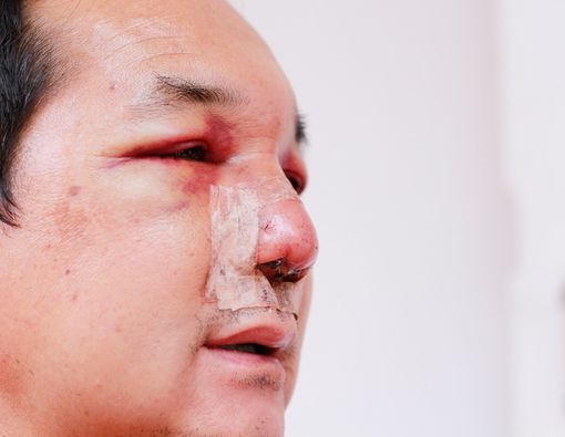 Berapa Lama Luka Akibat Operasi Plastik Bisa Pulih?