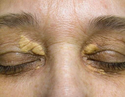 Xantoma, Penyakit Kulit Akibat Kolesterol Tinggi