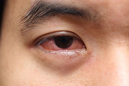 10 Penyebab Mata Merah yang Tidak Boleh Disepelekan