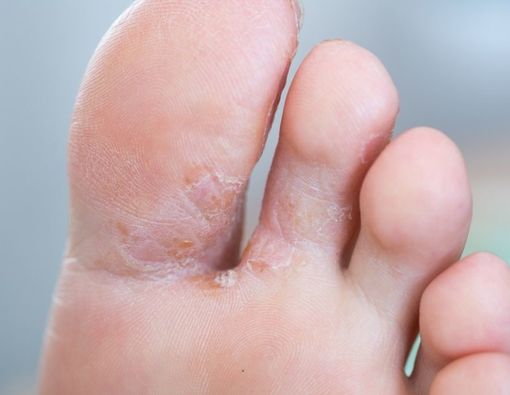 Kulit di Sela Jari Kaki Bersisik, Alergi atau Kutu Air?