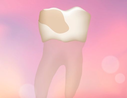 Penyebab Erosi Gigi pada Penderita GERD