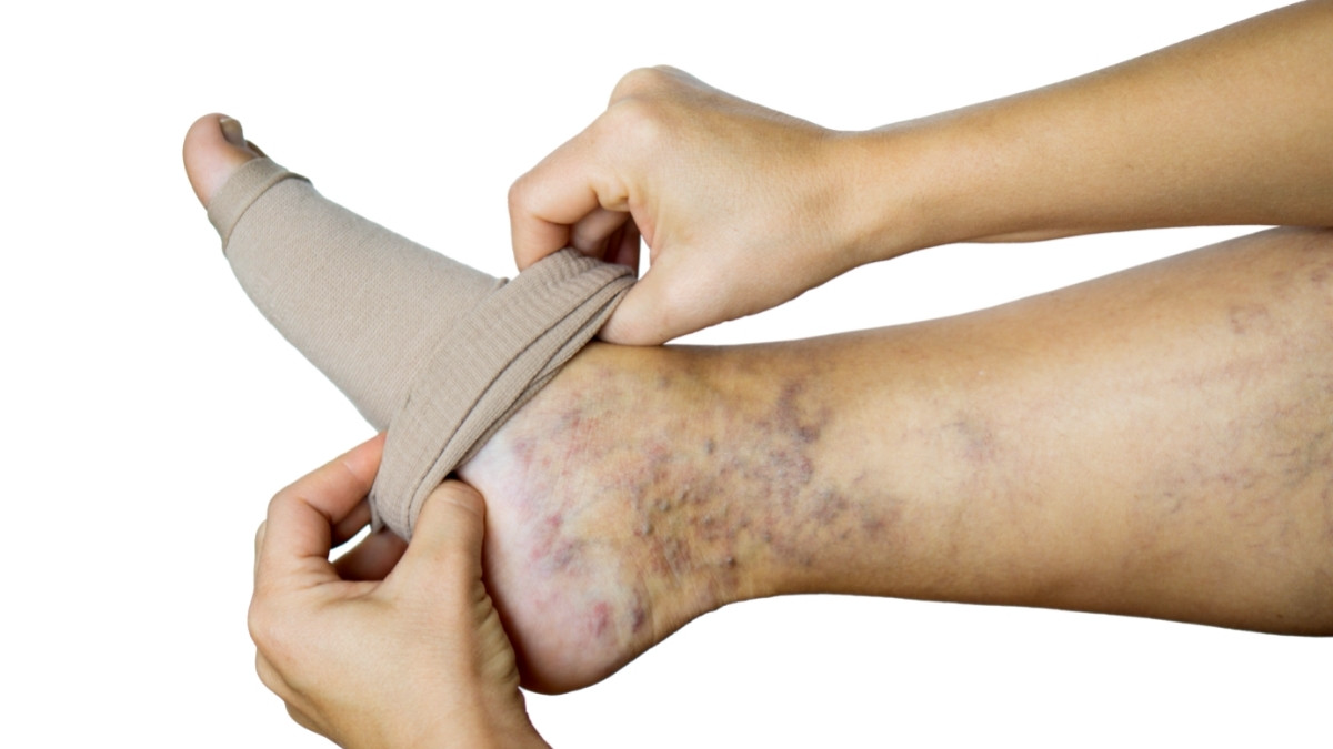 Stoking untuk Varises