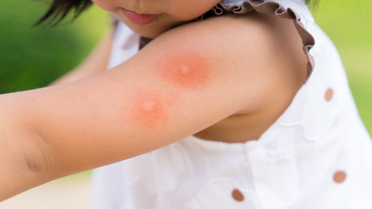 Jelang Musim Pancaroba, Awas Berbagai Penyakit Ini Mengintai Anak