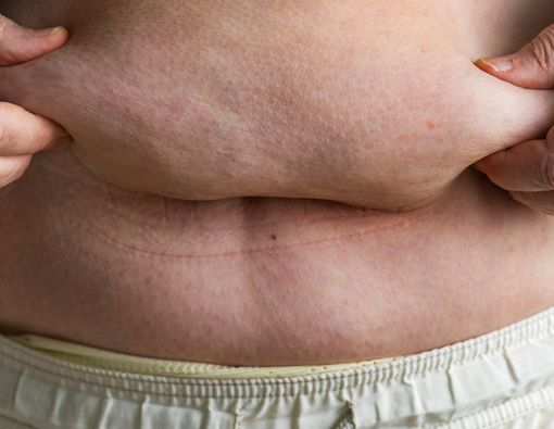 Waspada, Obesitas Bisa Menjadi Faktor Risiko Kanker Kolon