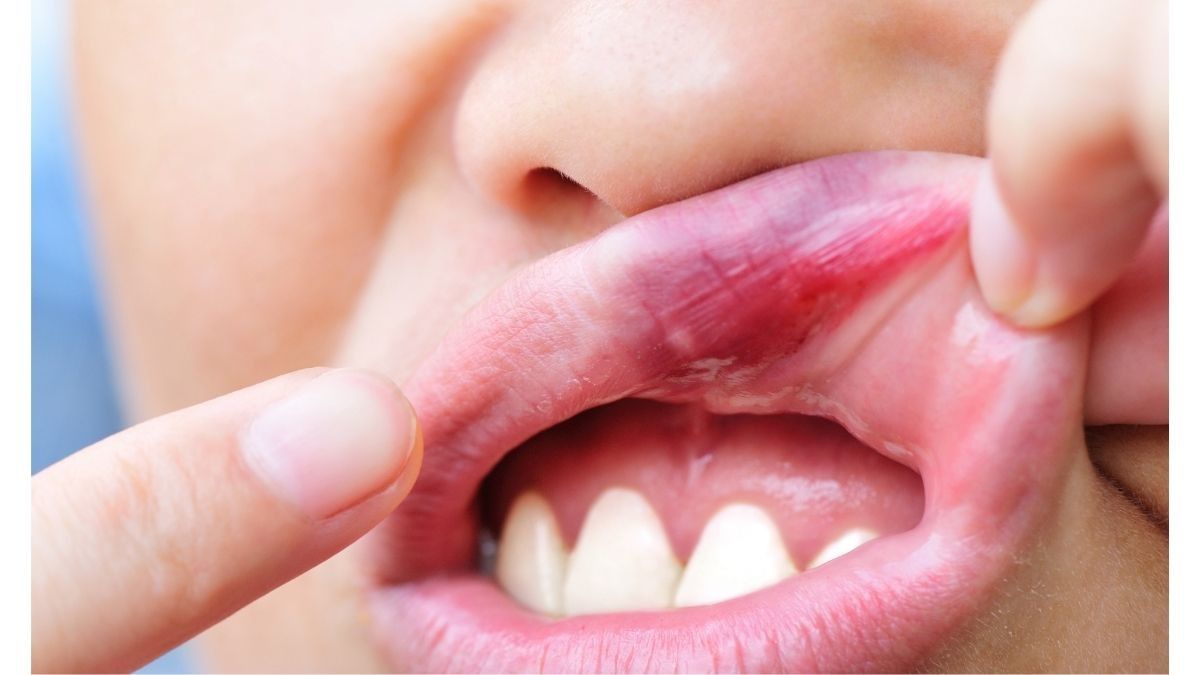 Perawatan untuk Robek Mulut Bagian Dalam
