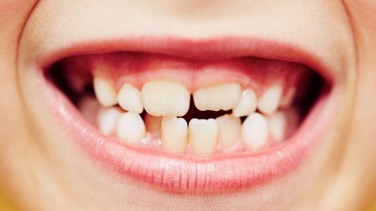 Berbagai Kelainan Bentuk Gigi yang Perlu Anda Tahu