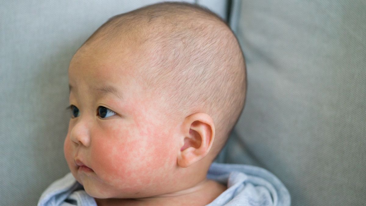 Eksim Susu pada Bayi, Kondisi Apakah Itu?