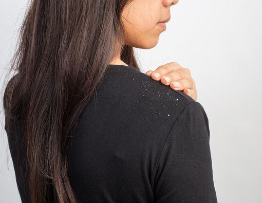 Jangan Abaikan, Ketombe Bisa Picu Gangguan Kesehatan