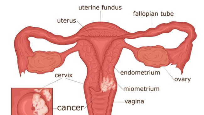Lindungi Diri dari Kanker Serviks, Lakukan Ini