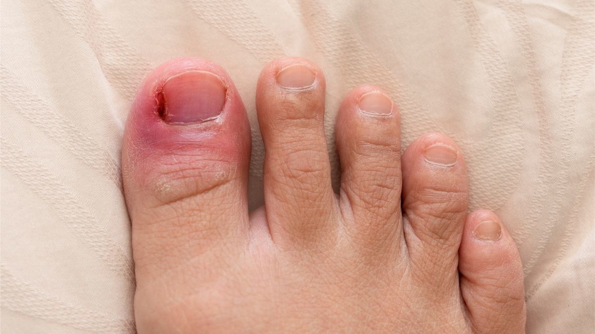 Jari Bengkak dan Merah Karena Udara Dingin, Awas Terkena Chilblains