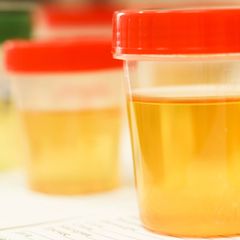Penyebab Urine Berwarna Kuning Setelah Minum Vitamin