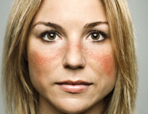 Ini Alasan Mengapa Wanita Lebih Rentan Kena Penyakit Lupus