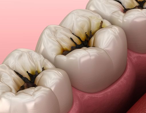 Tanda Penyakit Rongga Mulut yang Jarang Disadari