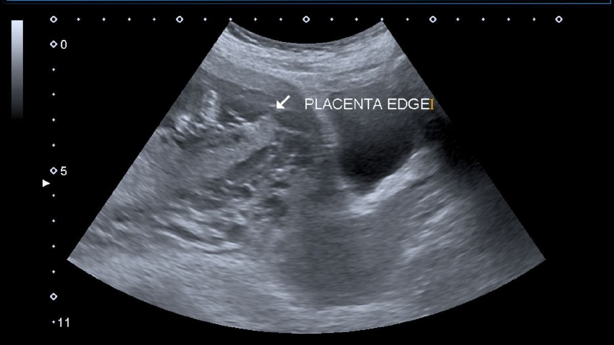 Mengenal Placental Lake dan Dampaknya Terhadap Kehamilan