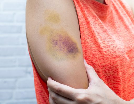 3 Cara Menghilangkan Memar di Tubuh Secara Alami