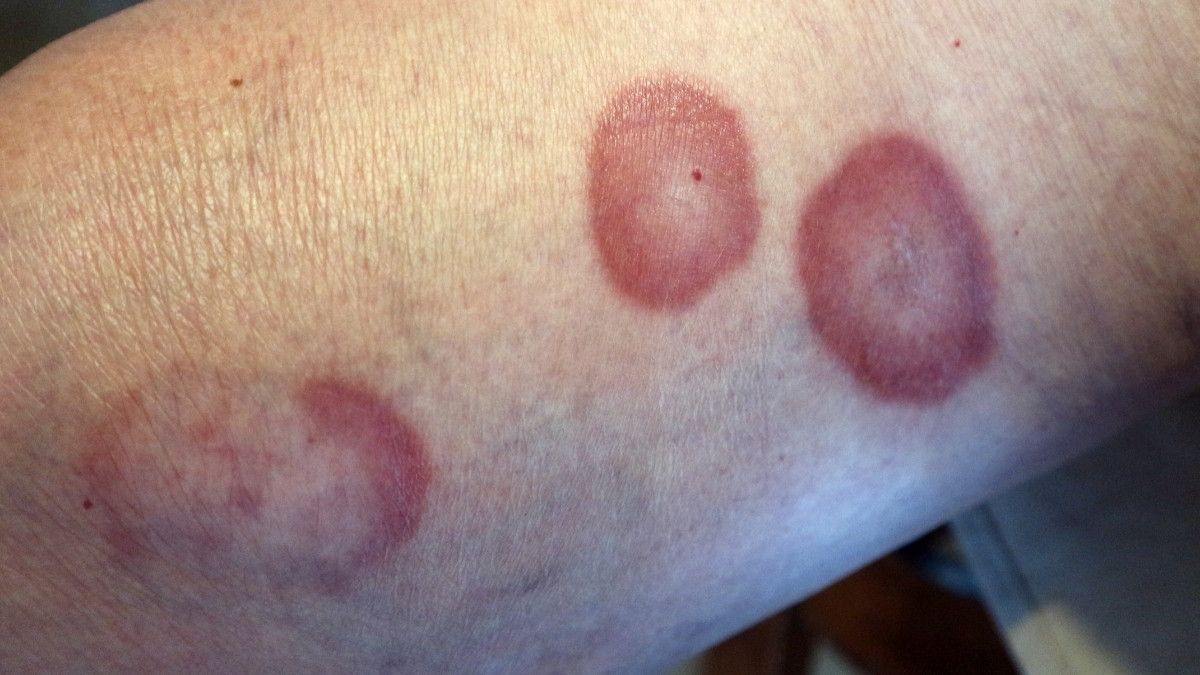 Mengenal Jenis-jenis Granuloma pada Bagian Tubuh