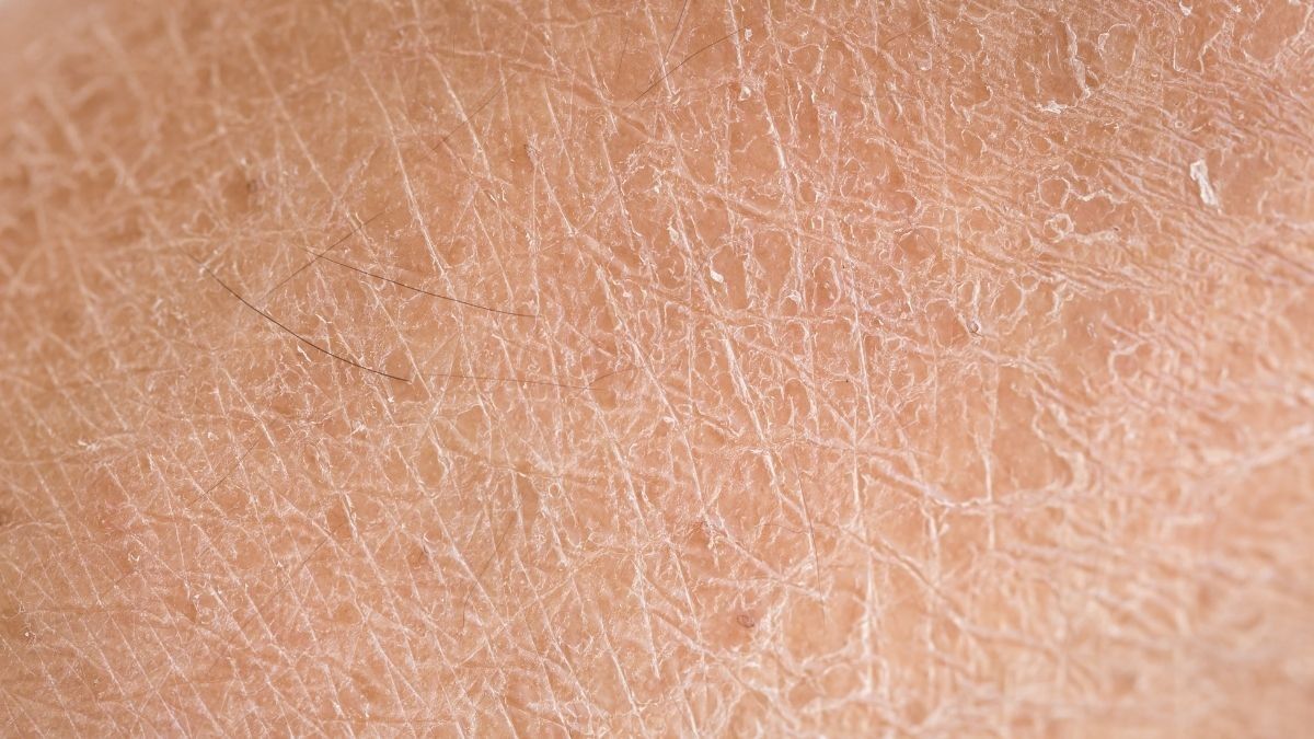 Harlequin Ichthyosis, Kelainan Kulit Langka Akibat Mutasi Genetik