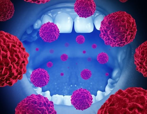 Komplikasi Kanker Mulut yang Perlu Diwaspadai