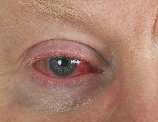 Solusi Mata Kering Saat Begadang Nonton Piala Dunia