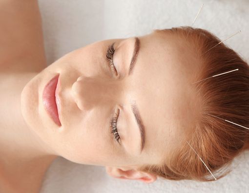 Terapi Akupunktur sebagai Cara Mengatasi Sakit Kepala, Efektifkah?