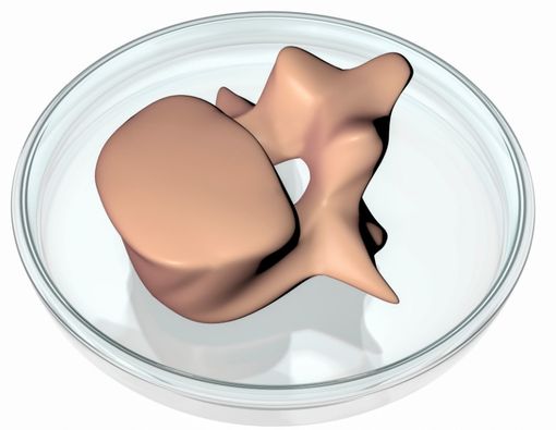 Mengenal Prosedur Pencakokan Tulang Lebih Dekat