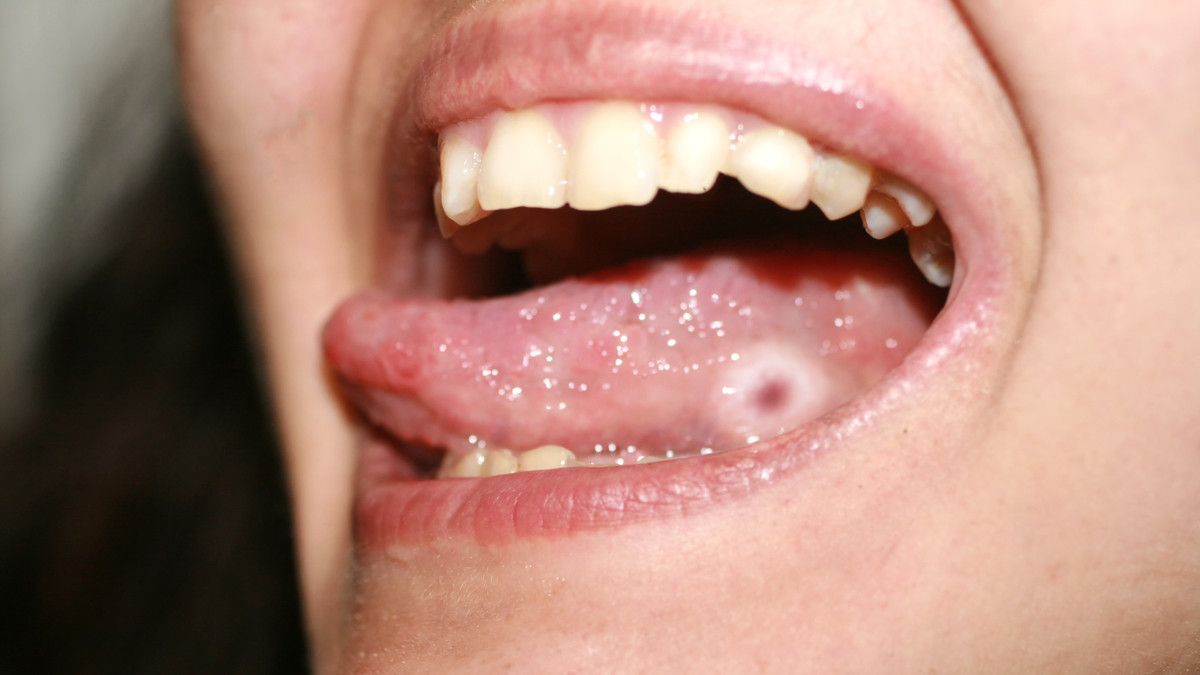 Kena Sifilis di Mulut, Kenali Penyebabnya dan Cara Mengatasinya!