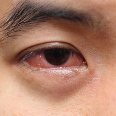 10 Penyebab Mata Merah yang Tidak Boleh Disepelekan
